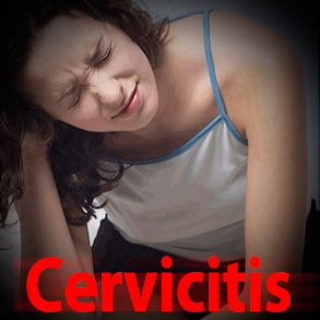 Cervicitis: Una enfermedad común en las mujeres y que no presenta síntomas