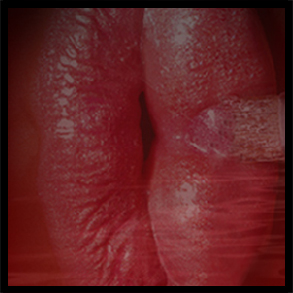 Rejuvenecimiento Vaginal (virgen otra vez)