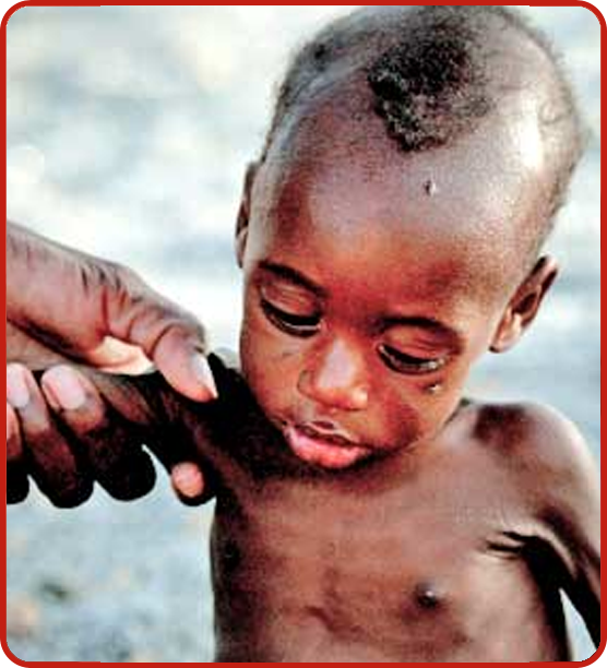 400.000 niños nacen con SIDA anualmente en África
